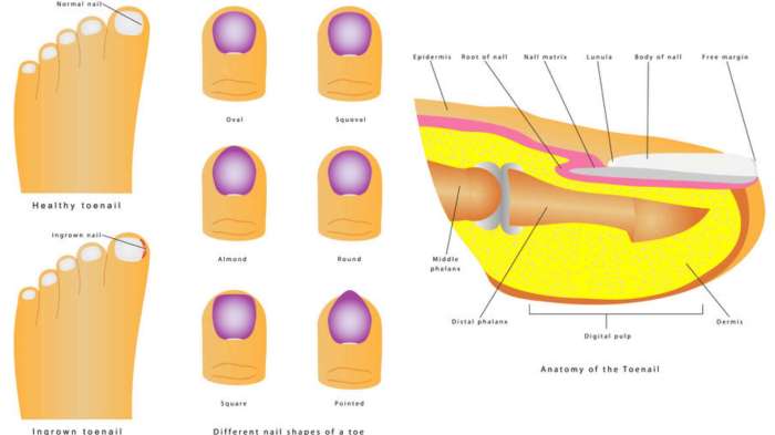 Ingrown toenail removal treatment