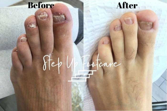 Fungus remove toenails toenail nail ingredients simple ways here good bed ingrown credit salt