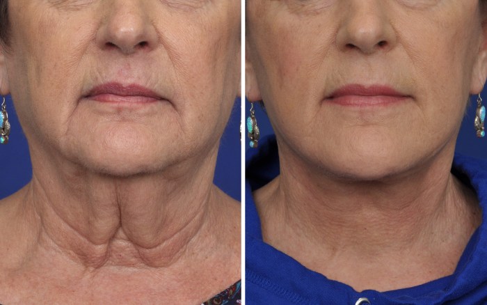 Lift facelift non surgical facial surgery procedure face before after mini fillers dr botox cosmetic spa med invasive mara front
