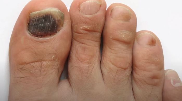 Toenail fungus remedies