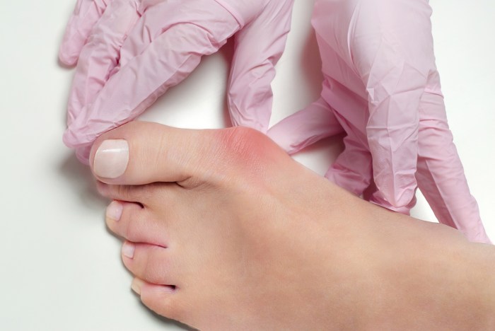Bunions treatment options